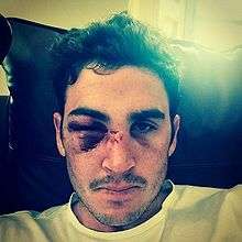 Kieswetter's face, with one eye closed, heavily bruised and coated in dry blood